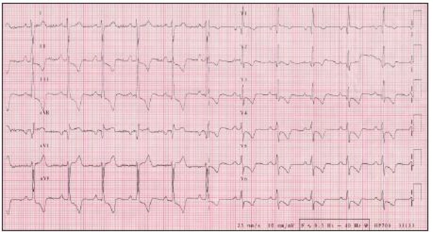 EKG z roku 2006, 5 rokov progredujúca dýchavičnosť, hypetrofi a a preťaženie pravého srdca.