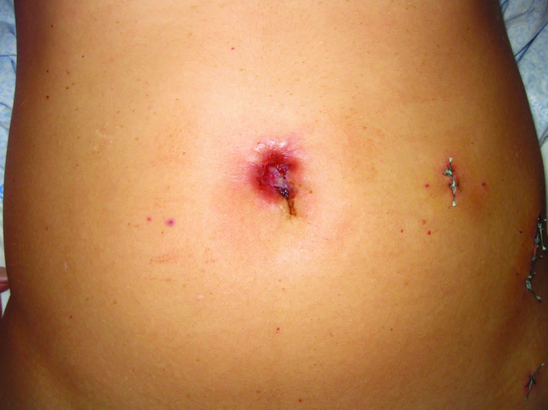 Ulcerace kůže v oblasti pupku podmíněná rozsáhlou invazivní peritoneální implantační metastázou.