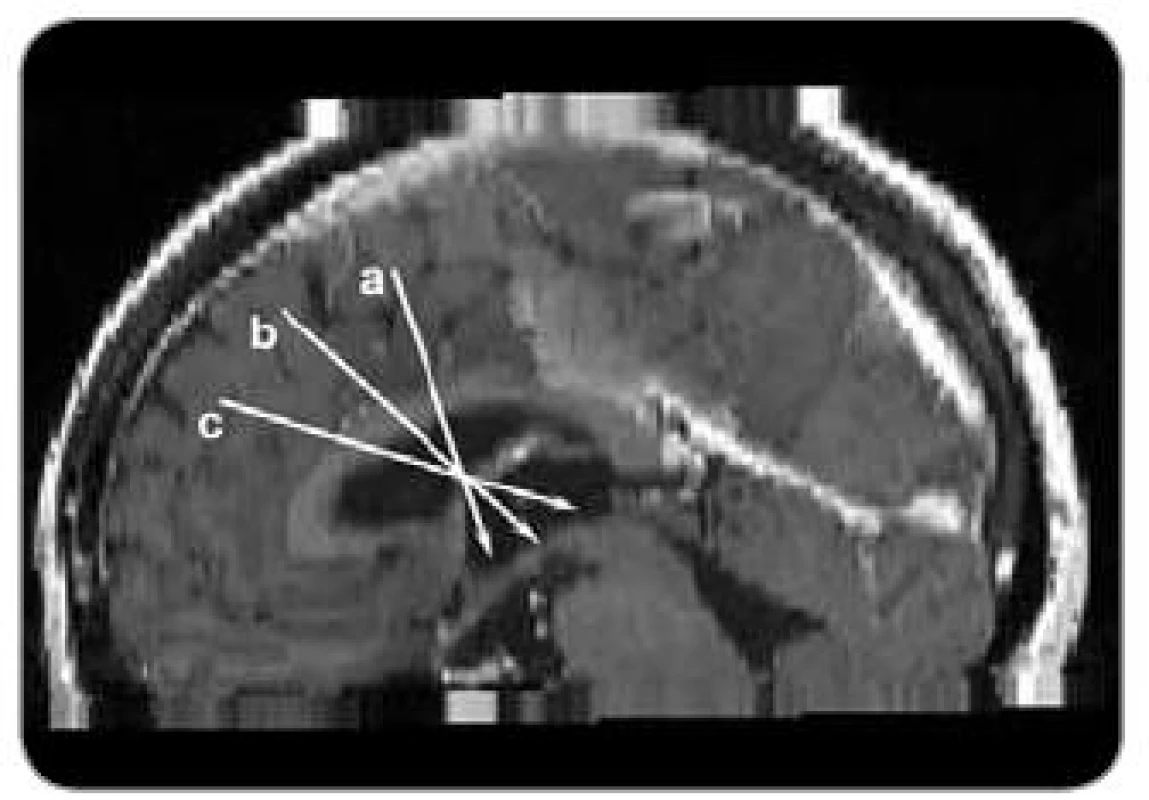 Směrnice trajektorií pro neuroendoskopickou operaci v jednotlivých částech II. komory. a) přední část II. komory, b) střední část III . komory, c) zadní část II. komory.