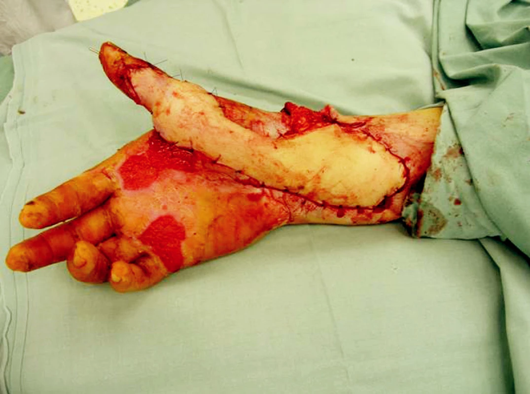 Microsurgically transferred parascapular fasciocutaneous flap to the soft tissues defect of right upper extremity