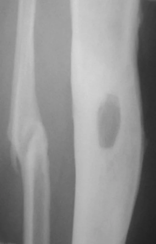 Detail RTG snímku pravého bérce 59letého pacienta s nálezem defektu přední kortikalis tibie v místě secernující píštěle