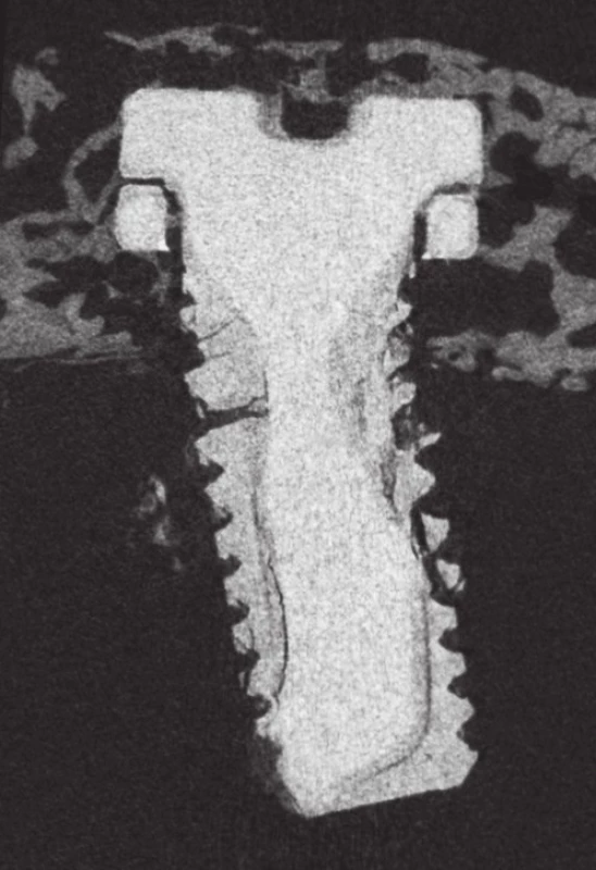 Microfocus CT, WE43 implantát v 16. týdnu; patrná je fraktura materiálu při jeho degradaci, ztráta původní kontury závitů