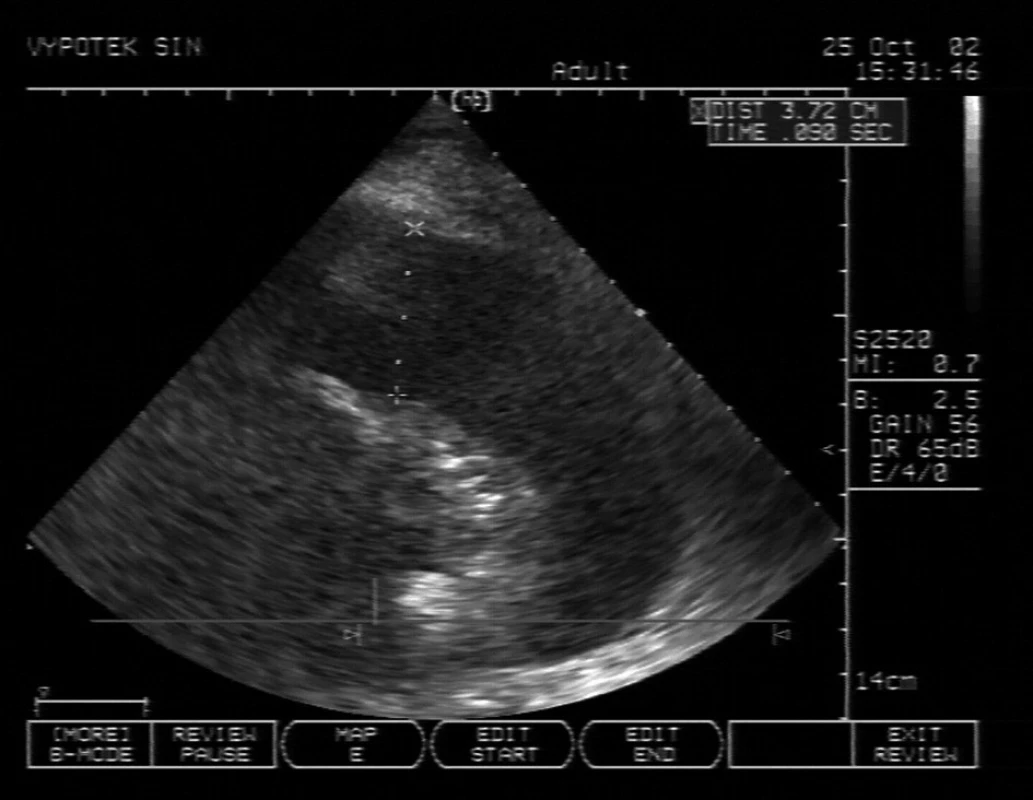Levostranný pleurální výpotek se separací 3,72 cm v zadní axilární čáře V centru UZ sektoru je atelektatická plíce, projasnění je bronchogram (vzduch v distálních bronchiolech).