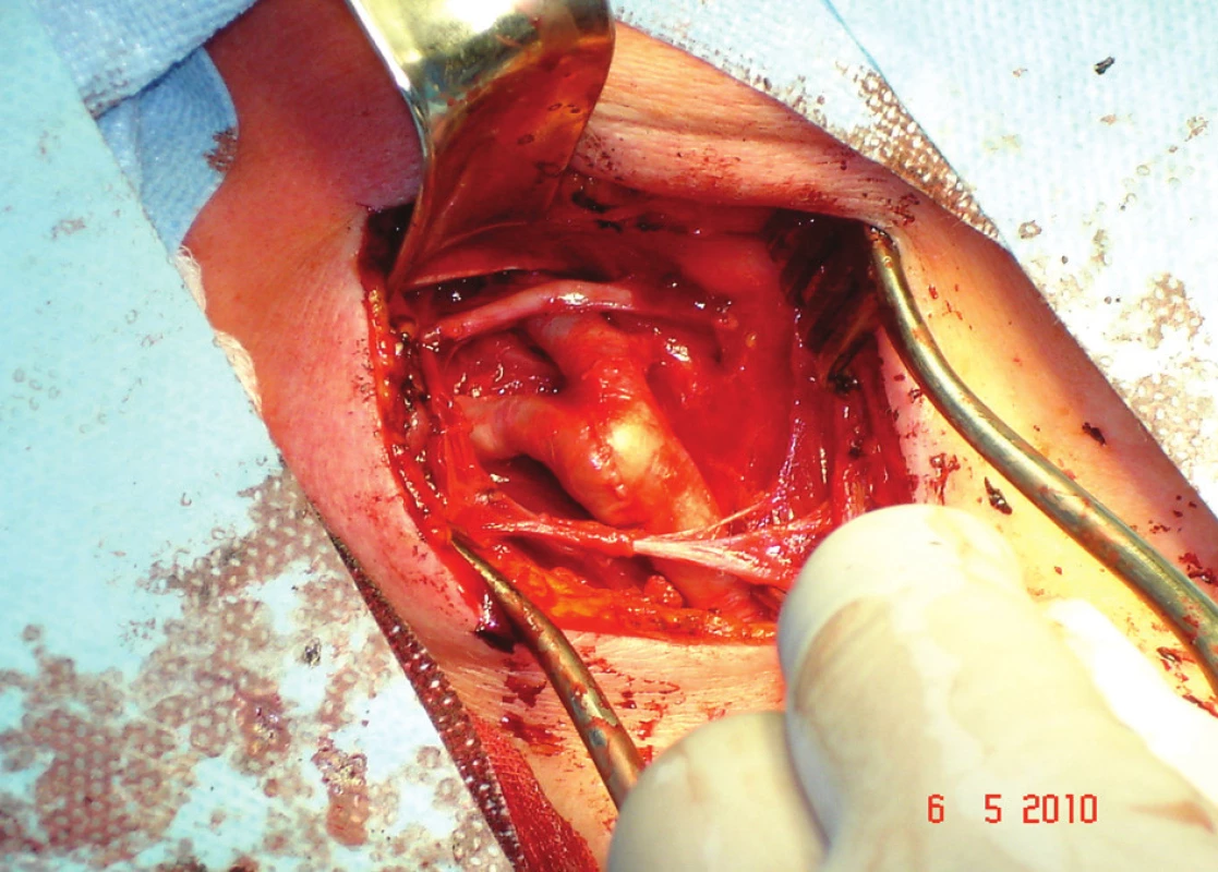 Dokončený operační výkon, neporaněný n.XII a cervikální ansa
Fig. 3: Completed surgery, uninjured n.XII and cervical ansa