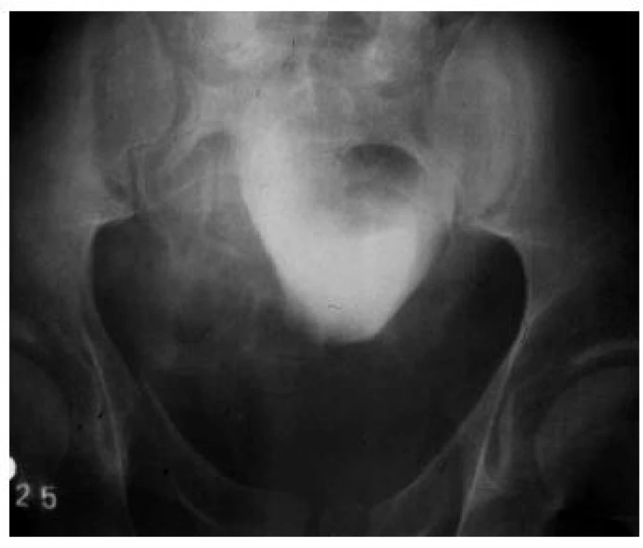 Cystografie při vylučovací urografii – kompletní ruptura zadní uretry s dislokací prostaty a močového měchýře kraniálně
Fig. 3. Cystography during excretory urography - complete rupture of the posterior urethra with cranial dislocation of the prostate and urinary bladder