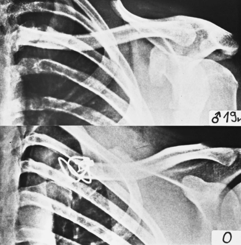 RTG snímek úrazový a snímek pooperační
Fig. 6. Preoperative and postoperative radiographs of extraarticular fracture of the medial end of the left clavicle