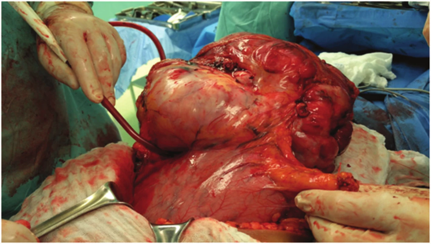 Oddělování tumoru od velké kurvatury žaludku
Fig. 4: Separation of the tumor from the greater curvature of the stomach