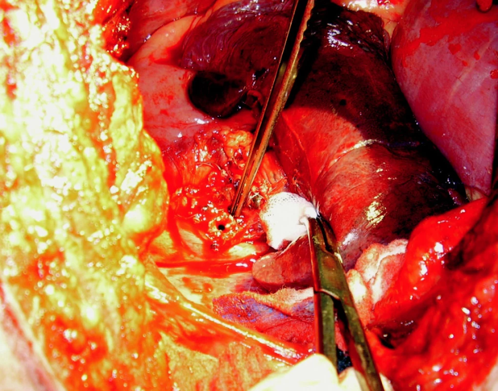Pinzeta ukazuje cholecysto-duodenální píštěl po odstranění žlučníku