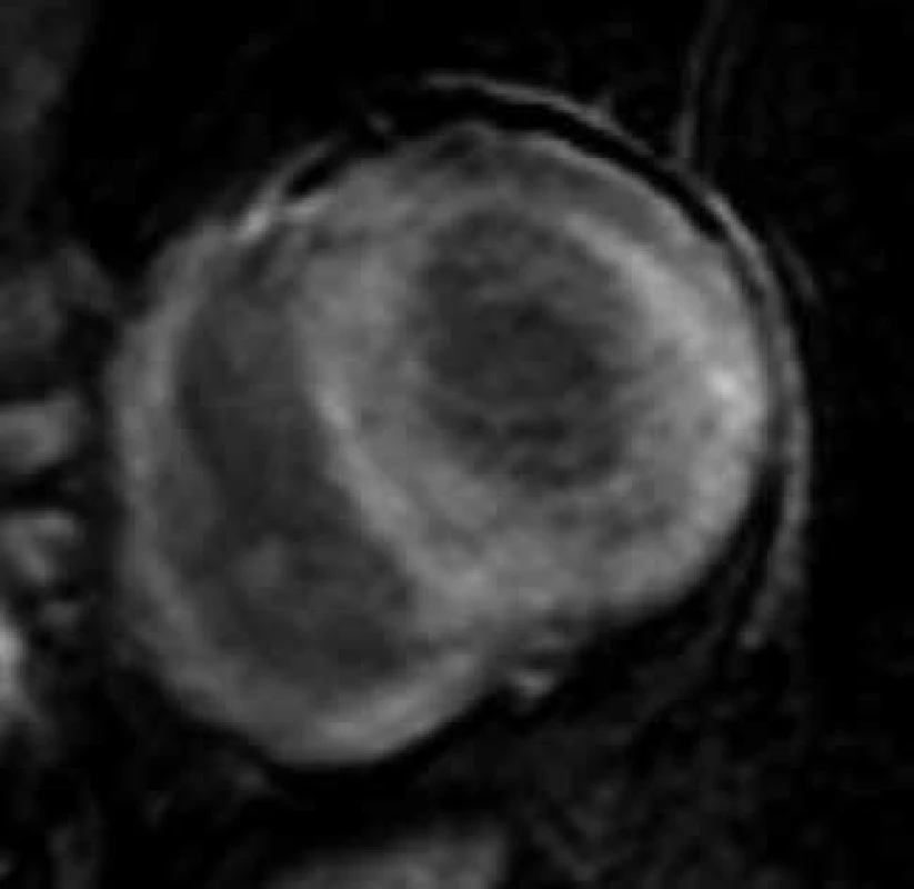 Difuzní, homogenní transmurální typ pozdního sycení kontrastní látkou (LGE) ve stěnách levé i pravé komory u nemocného s pokročilou amyloidovou kardiomyopatií;