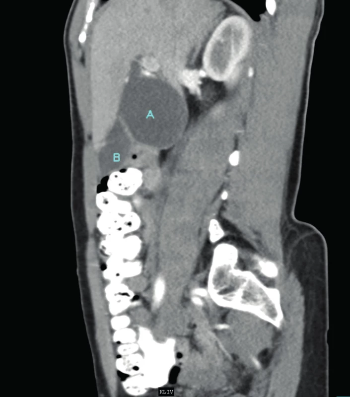 CT břicha v sagitální rovině (A – cysta ductus choledochus (v horní části ústí choledochu), B – žlučník)
Fig. 2: Sagittal abdominal CT image (A – choledochal cyst (ostium of the common bile duct in the upper part), B – gall bladder)