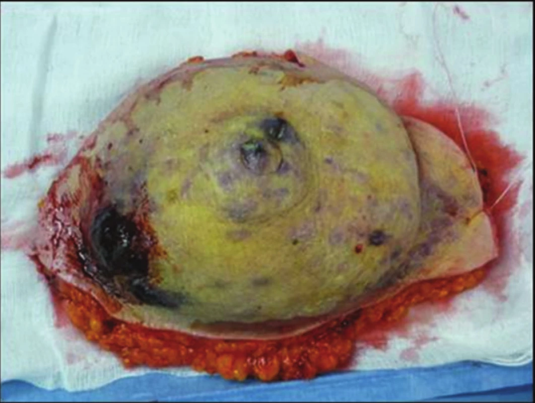 Snesený prs s mnohočetnými uzly angiosarkomu
Fig. 2: Multiple nodes of angiosarcoma in ablated breast