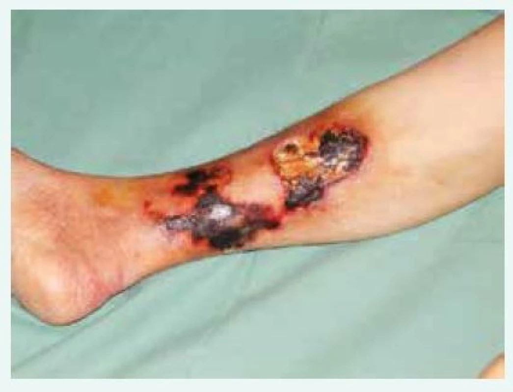Bolestivé kožní léze, fialové skvrny či podkožní uzly postupně progredují v ulcerace a nekrózy s nafialovělým lemem