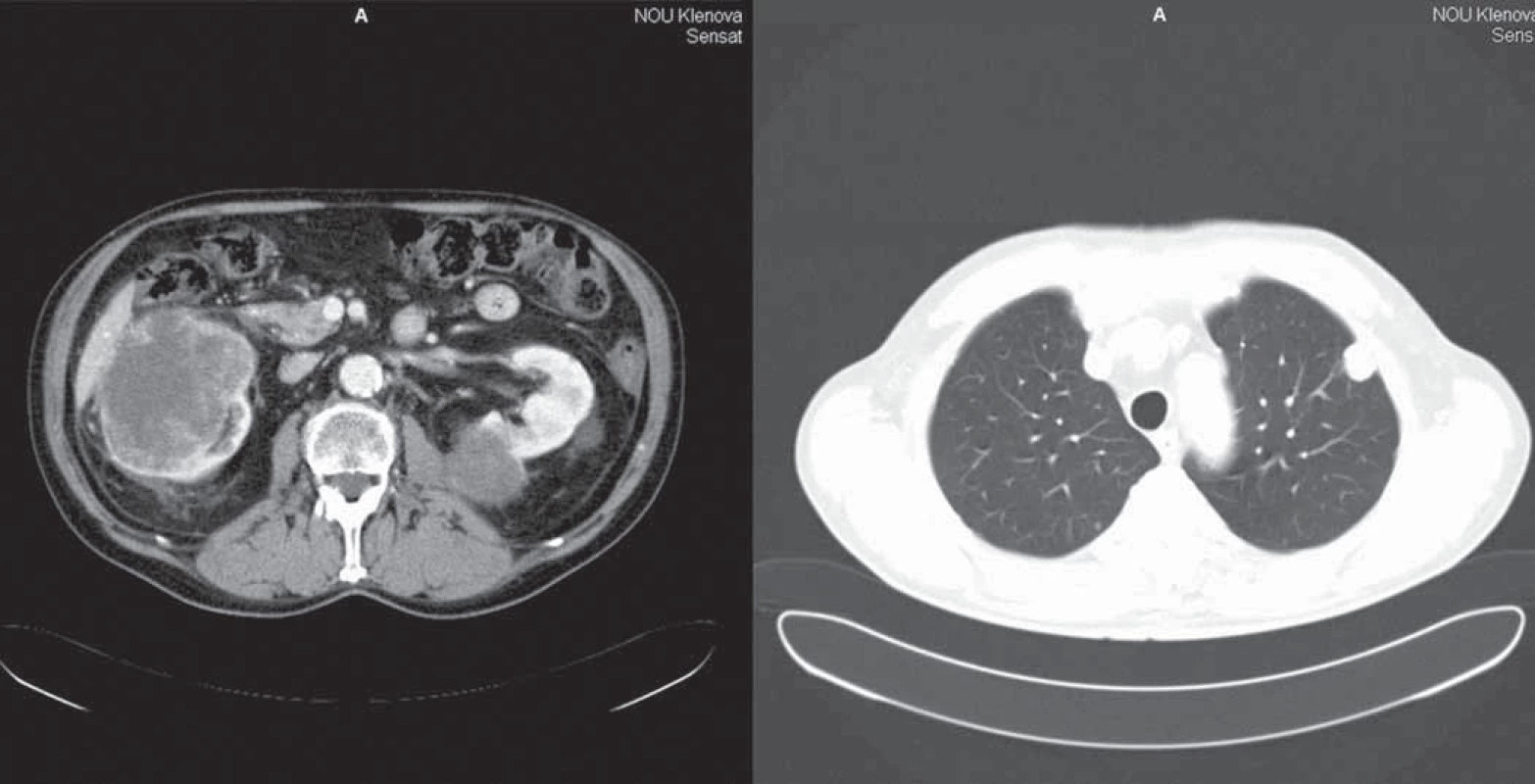 CT vyšetrenie hrudníka a abdomenu 16. 4. 2009.