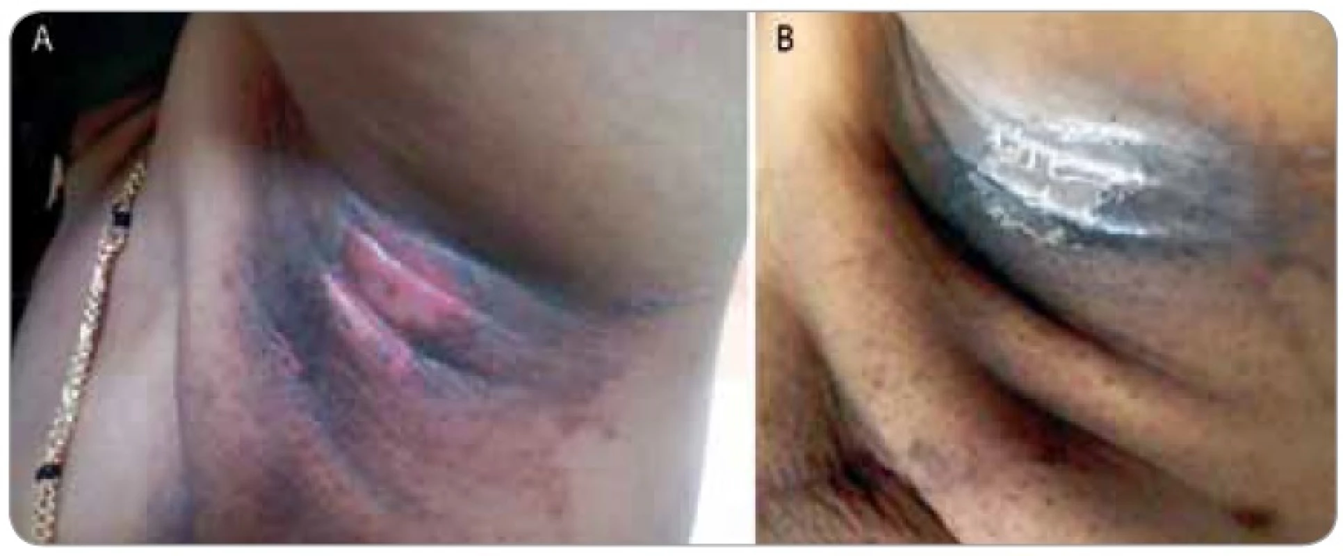 Shows a female patient who completed 50 Gy in 25 fractions radiotherapy for a breast cancer presented with grade III moist dequmation in the axillary fold (Superficial dermal exposure) (1A). The patient was referred to us for cytokine therapy. The skin ulceration healed in the next 4 days after GCSF injection (1B).