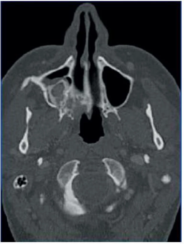 Axiální CT řez – tumor maxily