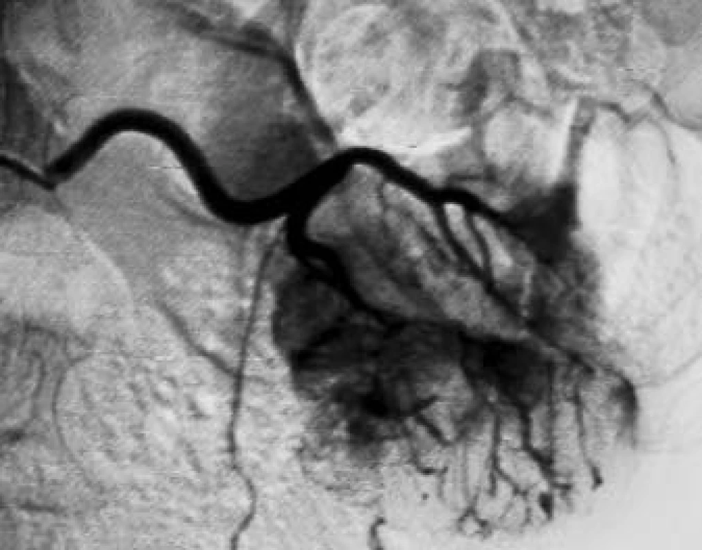 Angiografie aberantní renální tepny zásobující dolní třetinu ledviny s patrnou typickou maligni vaskularizací Grawitzova tumoru.