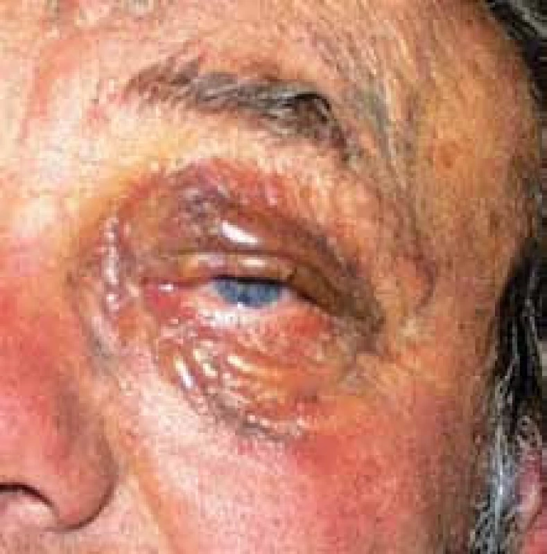 Lymfangiomatóza postihující obě oči.