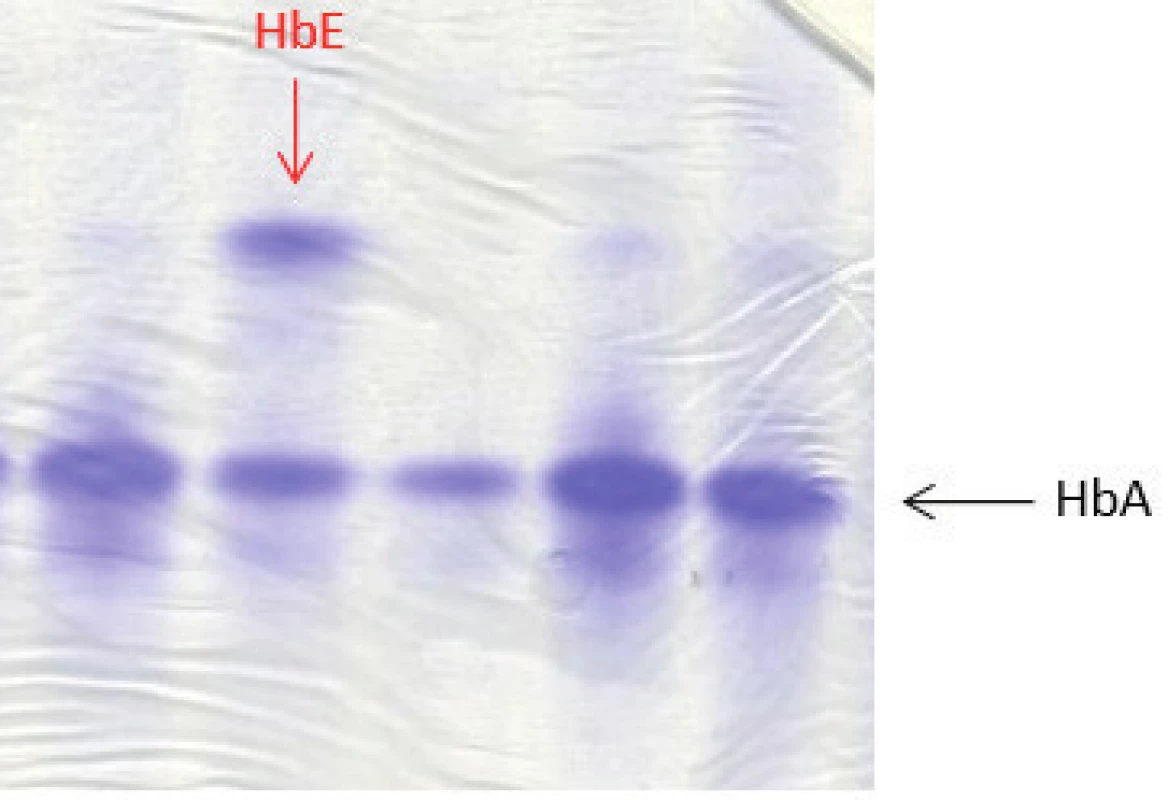 Proteinová elektroforéza (polyakrylamidový gel – PAGE) barvený Coomasie blue. Na obrázku zobrazené frakce hemoglobinového spektra HbA a HbE. Potvrzení nosičství alely pro HbE u našeho dětského pacienta bylo provedeno pomocí molekulárně genetického vyšetření (sekvenační analýzou). (Hemato-onkologická klinika, FN a LF Univerzity Palackého v Olomouci)
Fig. 4. Protein electrophoresis (polyacrylamide gel – PAGE) stained with Coomasie blue showing fractions HbA and HbE of the hemoglobin spectrum. HbE allele in a patient with HbE trait was confirmed by sequencing analysis.