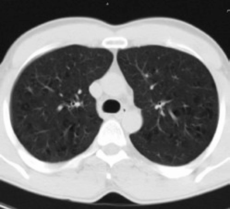 Difuzní zvýšení opacity plicního parenchymu a plicní cysty, ojediněle plicní nodularity.