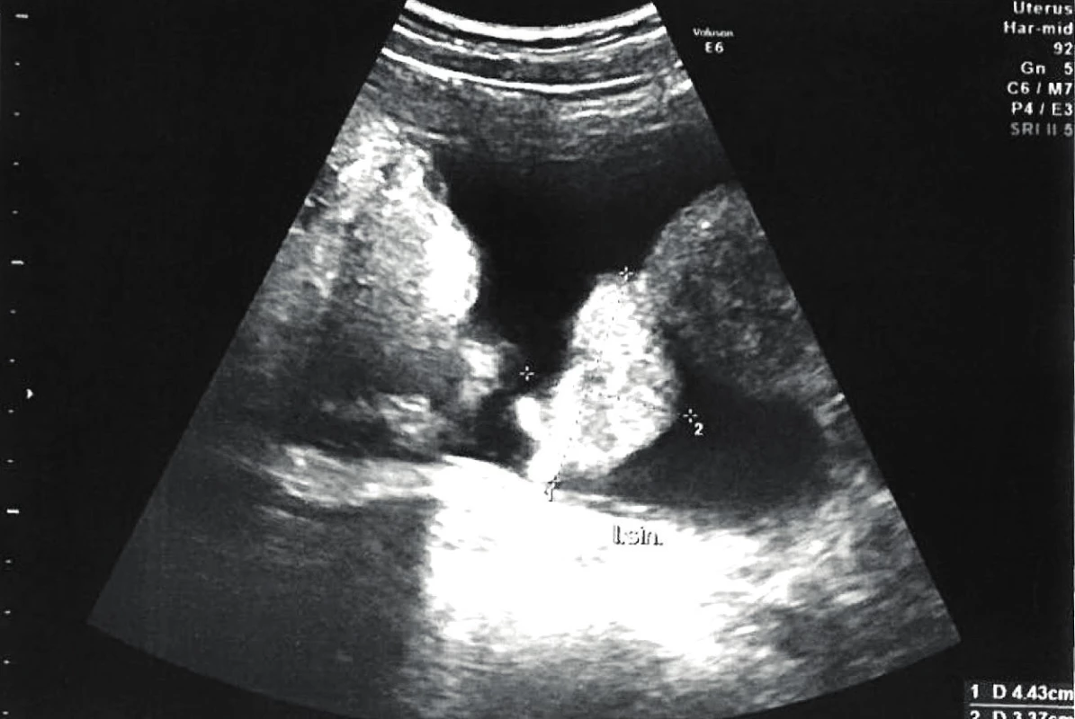Ultrazvukový snímek malé pánve: výrazně dilatován levý vejcovod, ascites