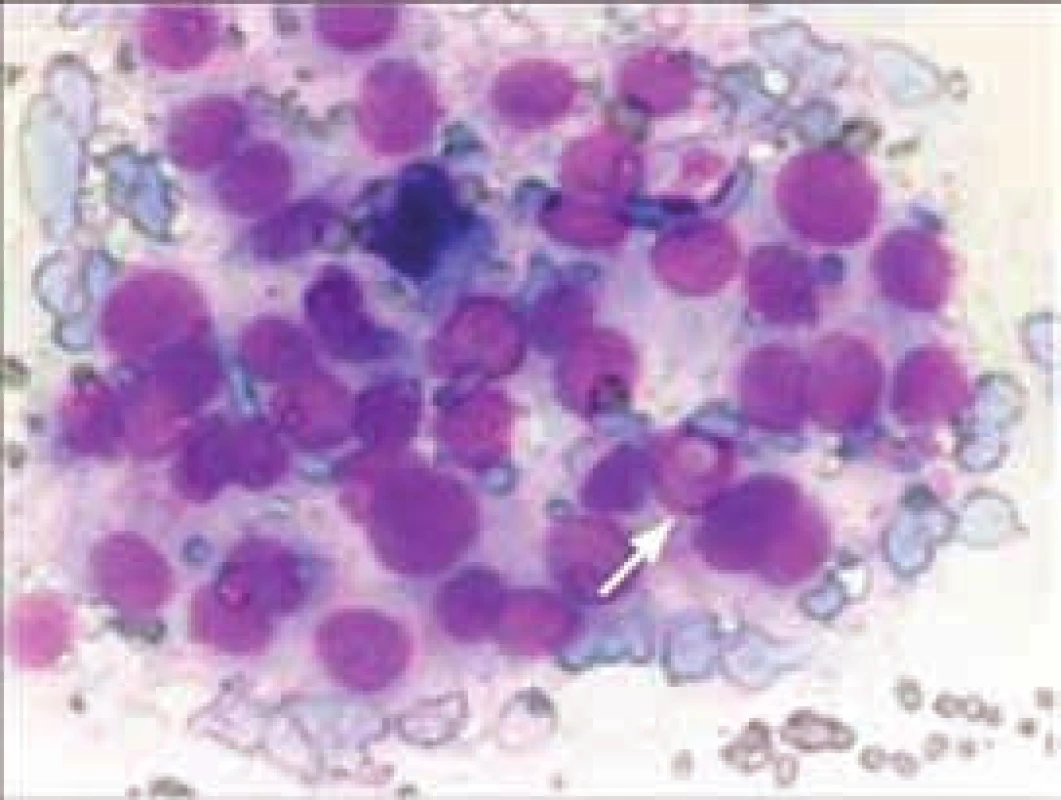 Cytologický obraz papilárního karcinomu
(zdroj: archiv prof. MUDr. J. Duškové, CSc., Ústav patologické anatomie 1. LF UK a VFN, Praha)