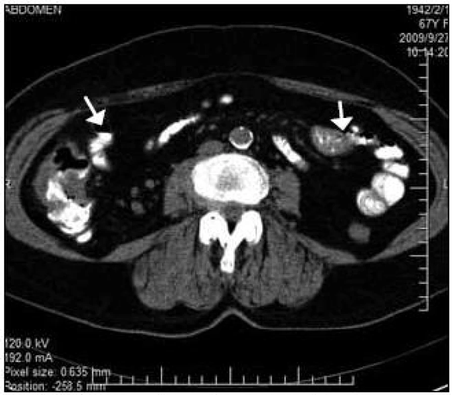 CT vyšetrenie. Na ľavej strane obrázka zhotoveného CT vyšetrením vidno transverzálny prierez ascendentnou časťou hrubého čreva s prítomnosťou kontrastnej látky v lúmene. 2 šípky upozorňujú na lokálne zhrubnutie steny čreva spôsobujúce výpadok kontrastnej látky v danej oblasti.