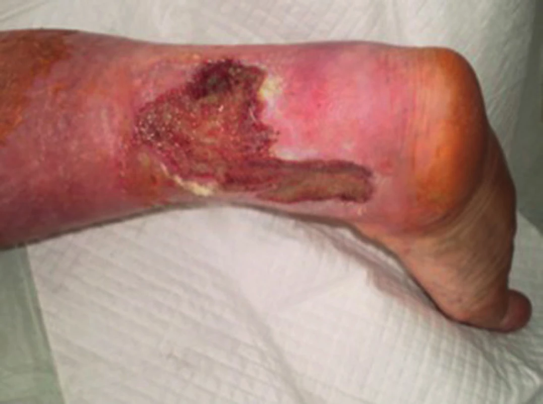 Pacient č. 1 − chronický kožní defekt po débridement a VAC terapii trvající 7 dnů
Fig. 4: Patient No. 1 − chronic wound after debridement and 7 days of VAC therapy