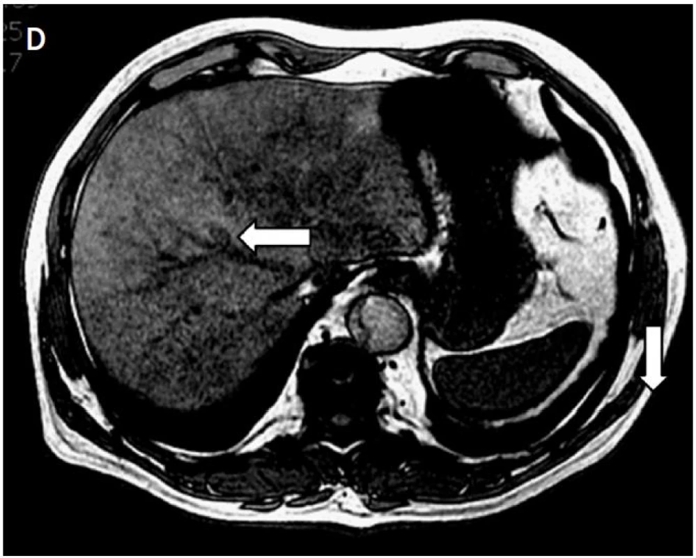 A – na axiálních MR skenech je patrná metastáza kolorektálního karcinomu v pravém jaterním laloku před IRE (šipky); B – uložení dvojice elektrod; C – ložisko nekrózy v místě původní metastázy 1 měsíc po IRE; D – regrese nekrotického ložiska při kontrole za 6 měsíců (šipka)