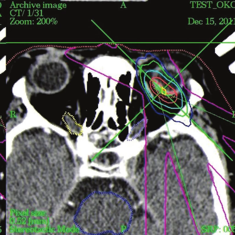 Detail CT obrazu - dávkové pole pri ožarovaní nádora v oku fotónmi, Tdmax – horná hranica dávky 37,5 Gy, terapeutická dávka TD 35,0 Gy