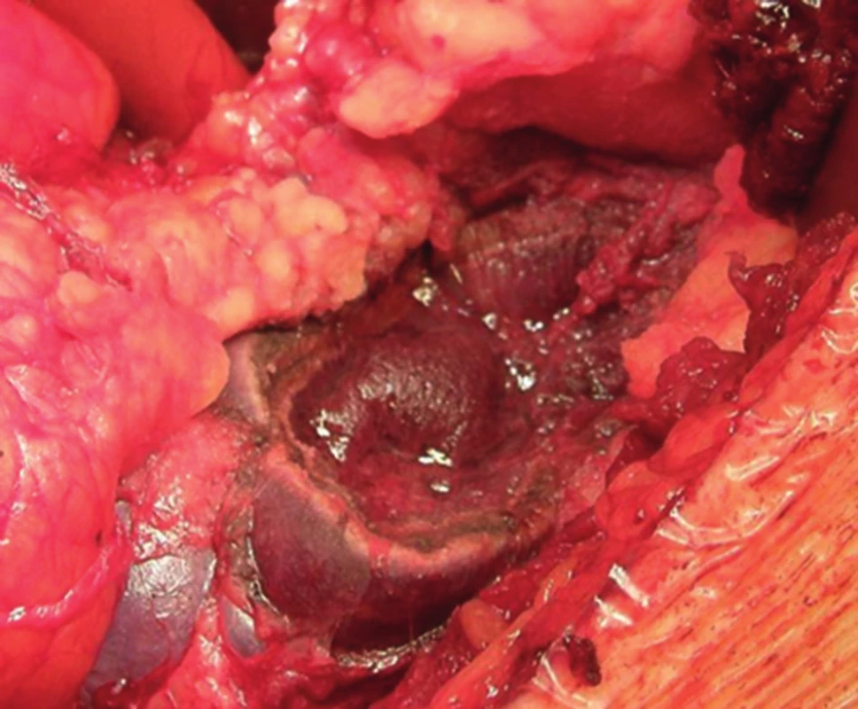 Tkáňové lepidlo na resekované ploše ledviny − otevřená operace
Fig. 2: Tissue glue on the resected kidney area − open surgery