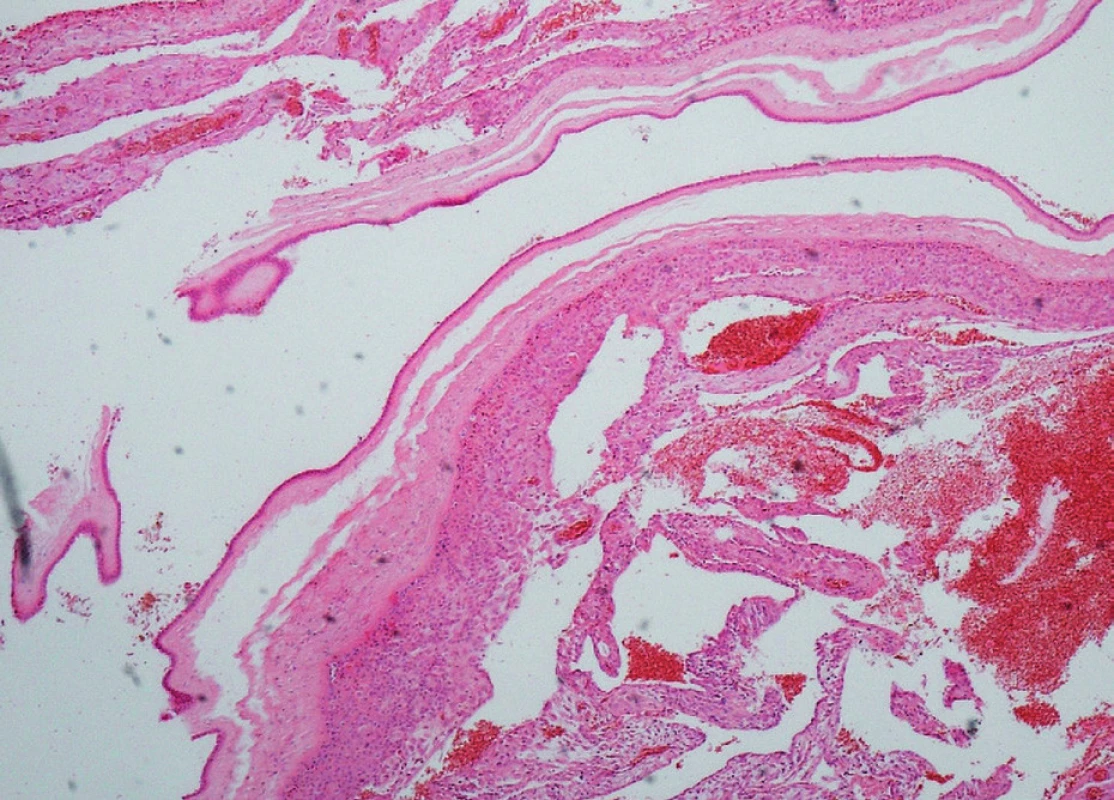 Překrvené obaly placenty se smíšeným zánětlivým infiltrátem v subchorionovém vazivu