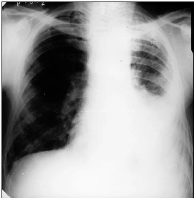 RTG pľúc v PA projekcii – diagnóza malígny mezotelióm pleury vľavo, fluidotorax laterobasalis l. sin.