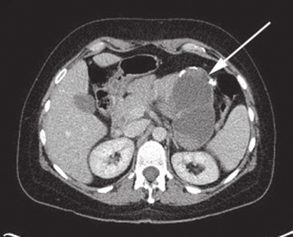 CT břicha s nálezem SPN v oblasti kaudy pankreatu
Fig. 1: Abdominal CT with the finding of SPN of the pancreatic tail