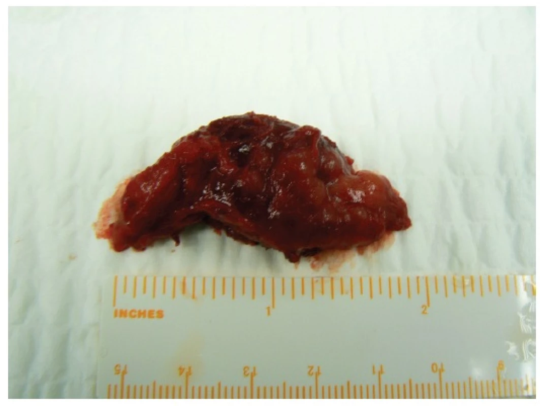 Preparát u téže pacientky po odstranění tumoru z parciální podélné sternotomie
Fig. 3: Tumour in the same patient after being removed from the partial longitudinal sternotomy