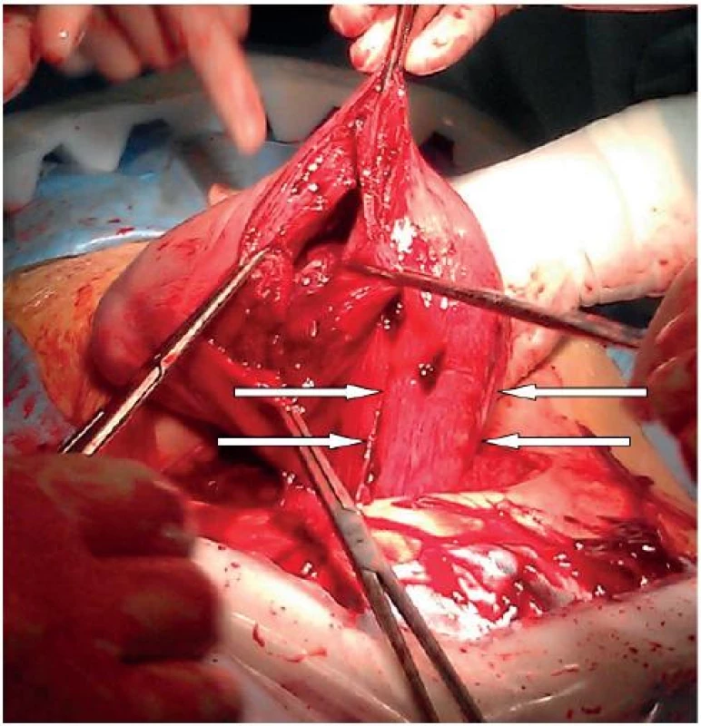 Pohled na dělohu během císařského řezu bezprostředně po vybavení plodu, šipkami označeno elongované děložní hrdlo