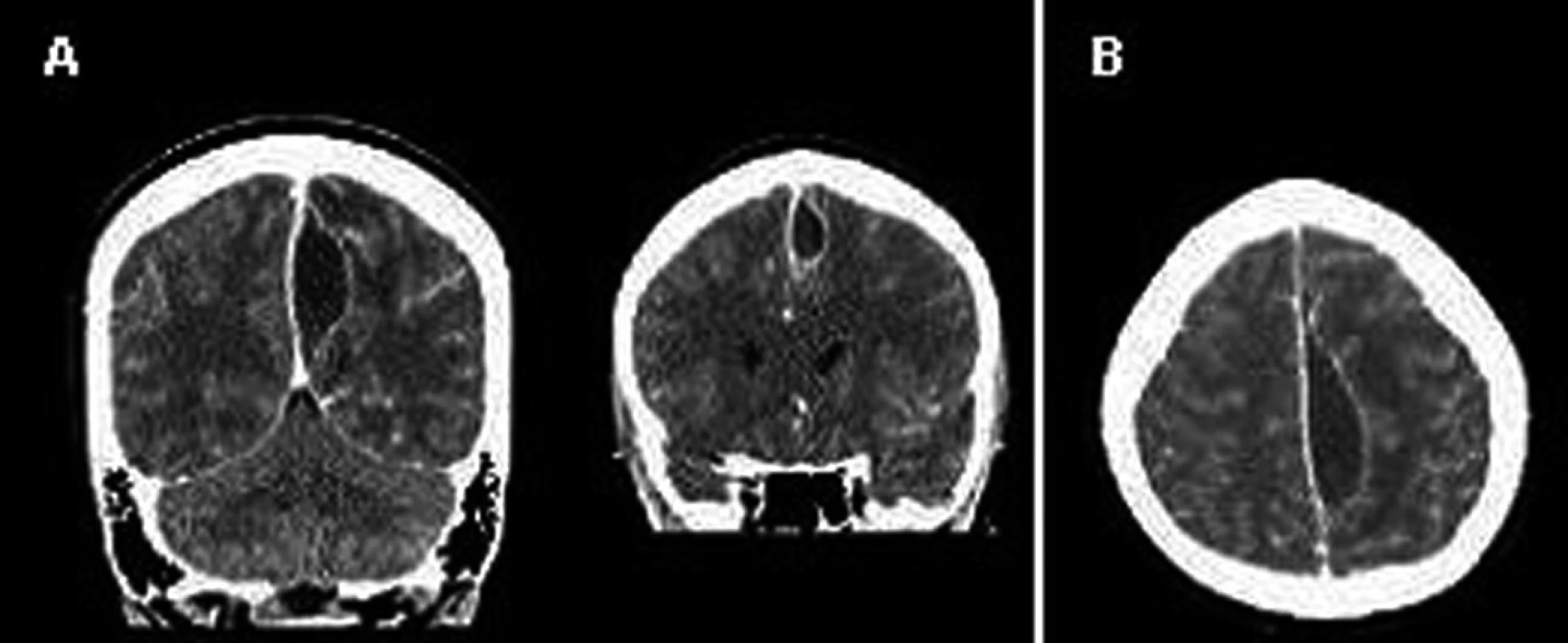 Intrakraniální absces v koronární (A) a axiální (B) projekci na CT mozku (20. den po primární endoskopické endonazální operaci)