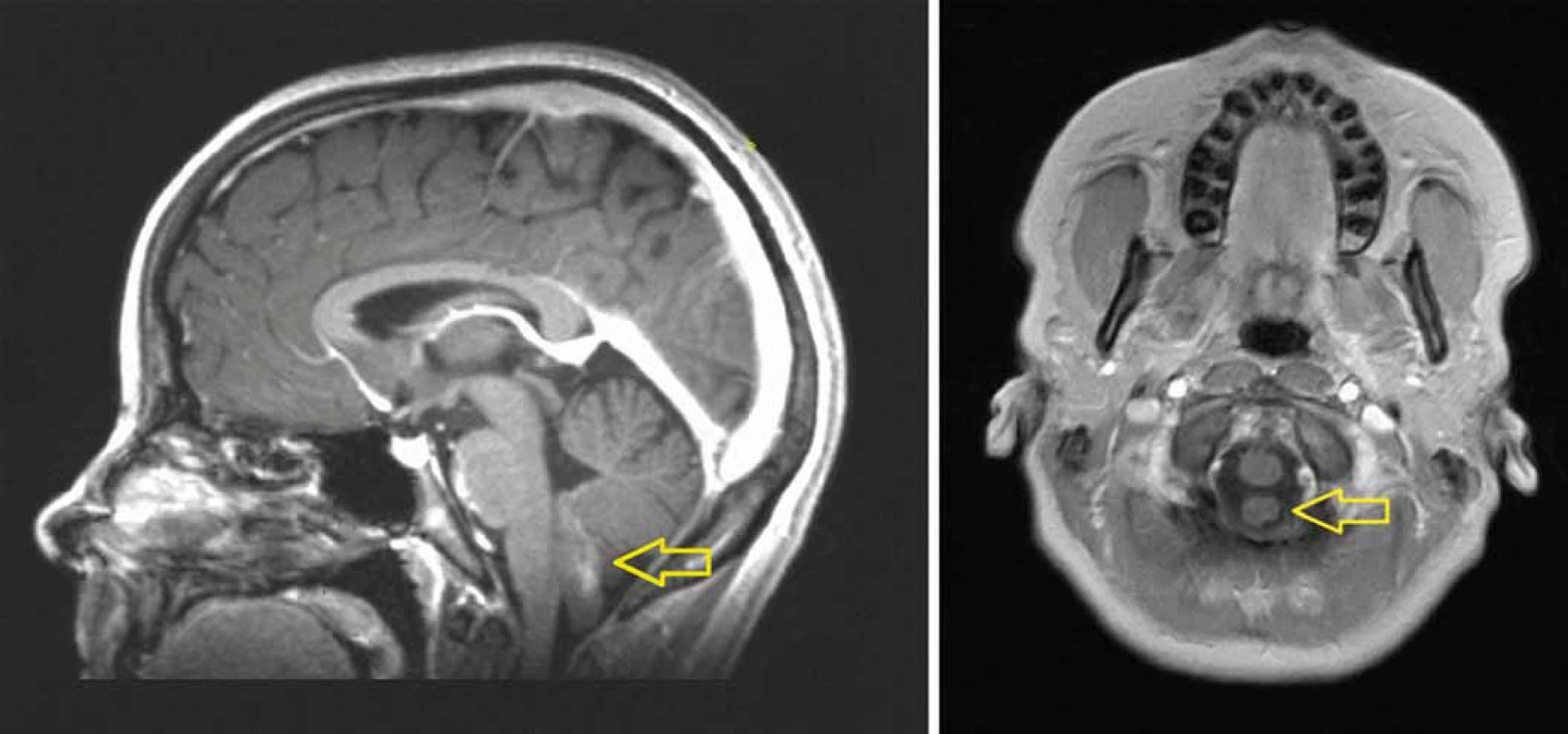MRI (T1 vážený obraz po podání kontrastní látky) ukazuje mírně enhancující „prstovitý“ tumor vyrůstající ze spodiny IV. komory mozkové a propagující se do velkého týlního otvoru (A). Tumor nesouvisí s prodlouženou míchou, je omýván mozkomíšním mokem (B).