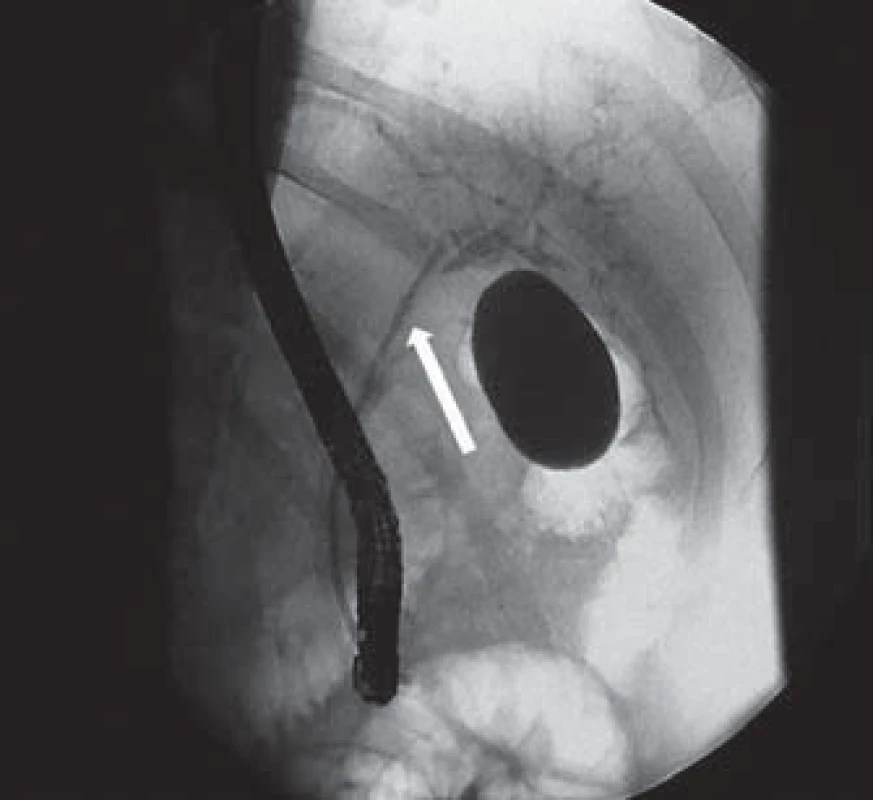 ERCP – zavedená biliární drenáž (7 Fr) do oblasti levého ductus hepaticus (šipka).
Fig. 3. ERCP – biliary drainage (7 Fr) inserted in the left hepatic duct (arrow).