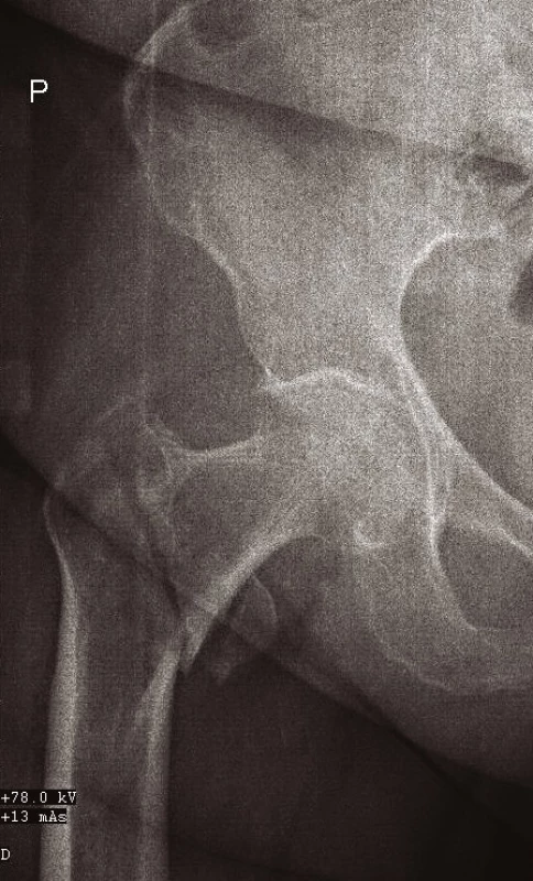 Přesný AP RTG snímek zlomeniny proximálního femuru