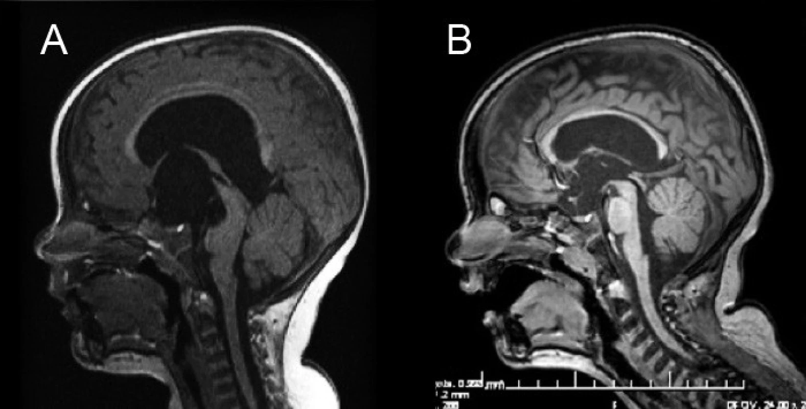 Magnetická rezonancia pacienta s hydrocefalom riešeným neuroendoskopicky – ETV. A – predoperačné MRI mozgu, B – kontrolné MRI 18 mesiacov po ETV.
Fig. 2. Magnetic resonance of a patient with hydrocephalus cured by neuroendoscopy – ETV. A – Preoperative MRI of the brain, B – control MRI 18 months after ETV.