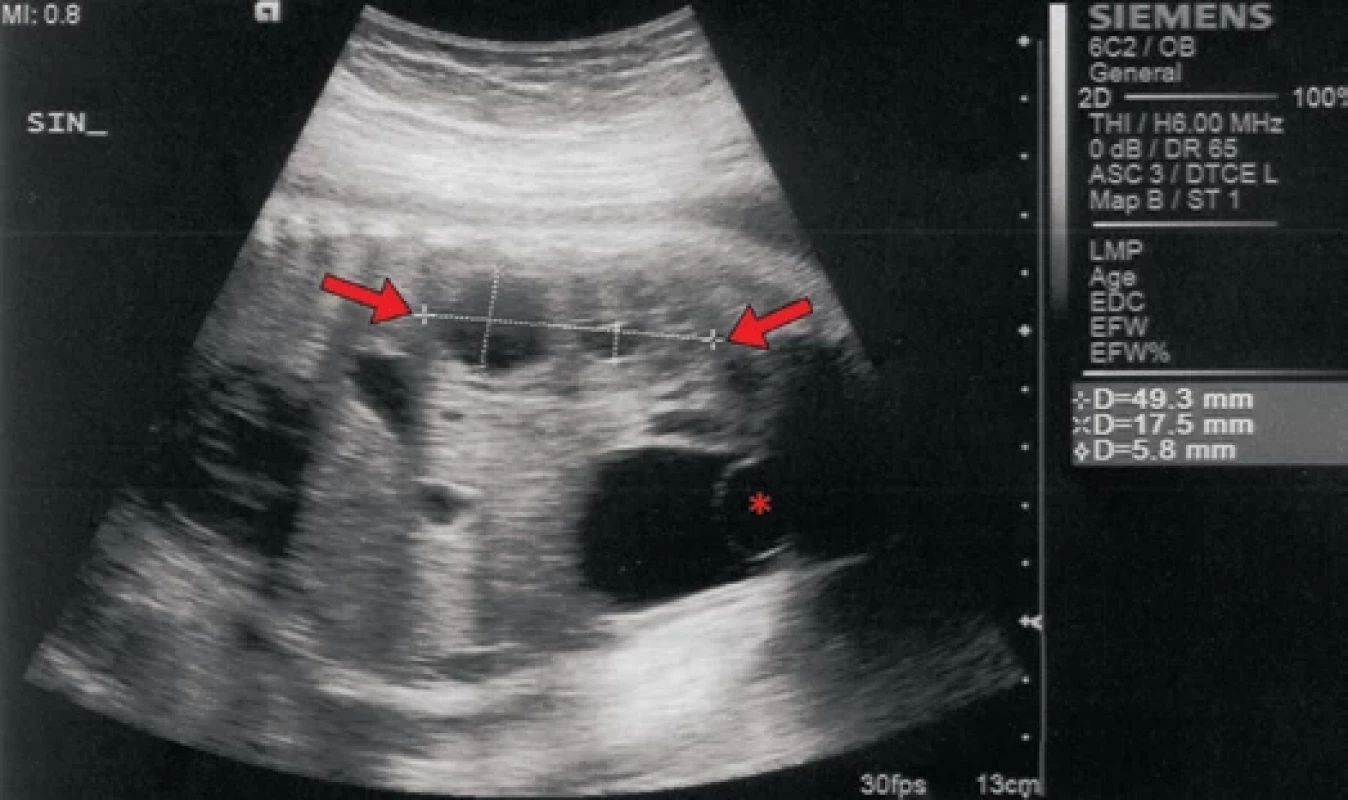 Ren duplex, ureterokéla. UZ snímek plodu, GT 31+2, po narození diagnóza potvrzena.
