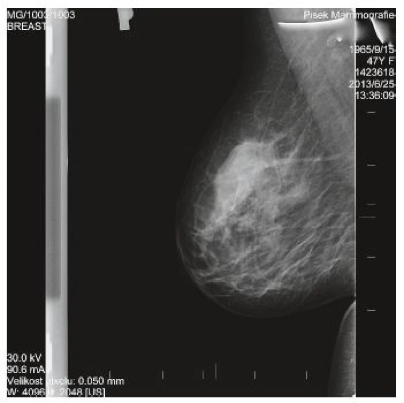 Mamografický obraz P prsu