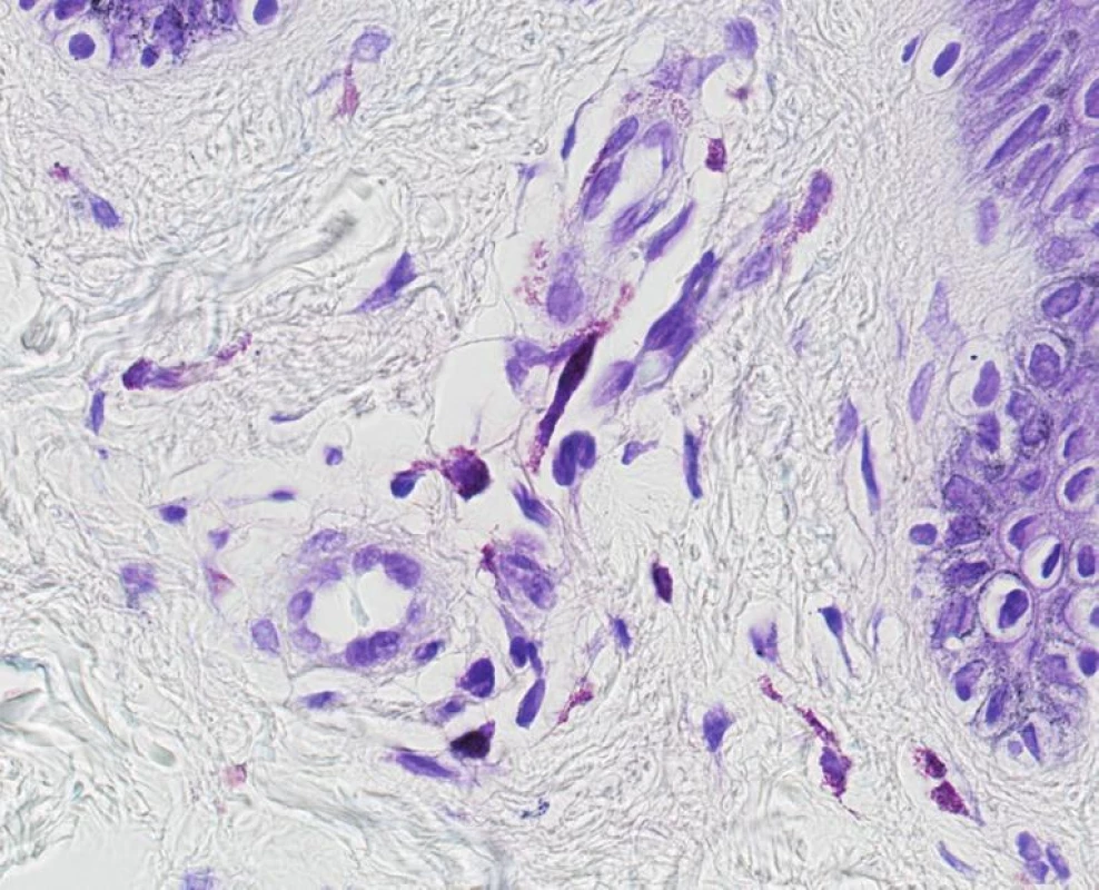 Teleangiectasia macularis eruptiva perstans. V barvení kresylvioletí je patrné hraniční zmnožení vřetenitých
žírných buněk. Odlišení od normálního stavu vyžaduje často korelaci s klinickým obrazem nebo i kontrolní excizi
z nepostižené kůže (obj. 60x, imerze).
