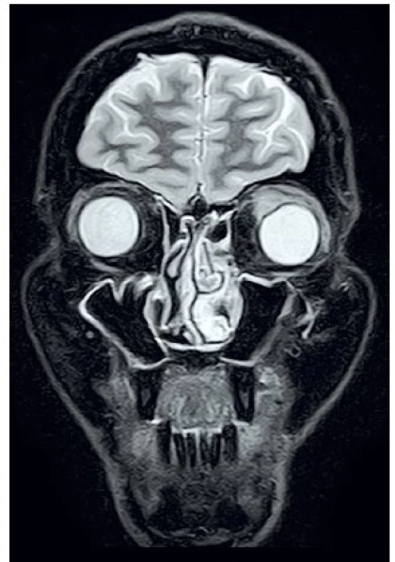 MRI očnic STIR, koronární řez – infiltrát levé orbity s útlakem bulbu