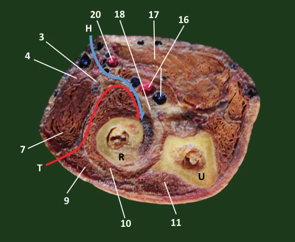 Průřez proximálním předloktím (pravá strana): a – schéma, b – preparát: 1 – n. cutaneus antebrachii lat., 2 – v. cephalica, 3 – r. superficialis n. radialis, 4 – m. brachioradialis, 5 – m. extensor carpi radialis longus, 6 – n. cutaneus antebarachii post., 7 – m. extensor carpi radialis brevis, 8 – r. profundus n. radialis, 9 – m. extensor digitorum, 10 – m. supinator, 11 – m. extensor carpi ulnaris, 12 – m. flexor carpi ulnaris, 13 – fascia antebrachii, 14 – n. ulnaris, 15 – a. ulnaris, 16 – a. et v. interossea communis, 17 – společná hlava flexorů předloktí, 18 – šlacha m. biceps brachii, 19 – n. medianus, 20 – a. et v. radialis, H – Henryho přístup, T – Thompsonův přístup, R – radius, U – ulna. &lt;i&gt;(Převzato z Bartoníček J. Operační přístupy u zlomenin hlavičky a diafýzy rádia. Acta Chir Orthop Traumatol Čech 1988;55:497−516.)&lt;/i&gt;
Fig. 1: Proximal forearm cross-section (right site): a – drawing, b – anatomic specimen: 1 – lateral cutaneous nerve of forearm, 2 – cephalic vein, 3 – superficial branch of radial nerve, 
4 – brachioradialis, 5 – extensor carpi radialis longus, 6 – posterior cutaneous nerve of forearm, 
7 – extensor carpi radialis brevis, 8 – deep branch of the radial nerve, 9 – extensor digitorum, 
10 – supinator, 11 – extensor carpi ulnaris, 12 – flexor carpi ulnaris, 13 – antebrachial fascia, 
14 – ulnar nerve, 15 – ulnar artery, 16 – common interosseous artery and vein, 17 – common head of forearm flexors, 18 – biceps brachii tendon, 19 – median nerve, 20 – radial artery and vein, 
H – Henry approach, T – Thompson approach, R – radius, U – ulna. &lt;i&gt;(Reprinted from Bartoníček J. [Surgical approaches in fractures of the head and shaft of radius].(Acta Chir Orthop Traumatol Čech 1988;55:497−516.)&lt;/i&gt;