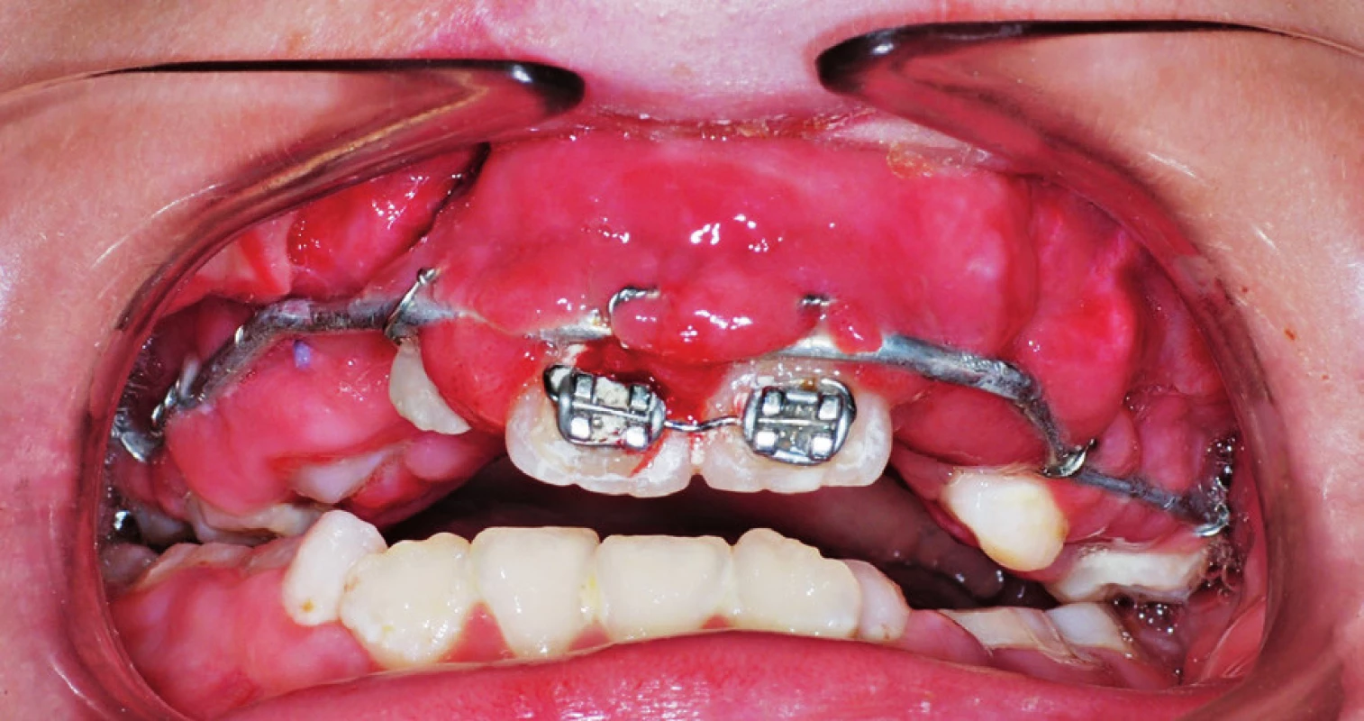 Patient with a bilateral cleft lip and palate after surgical repositioning of premaxilla in which position of premaxilla was fixed with Sauer splint