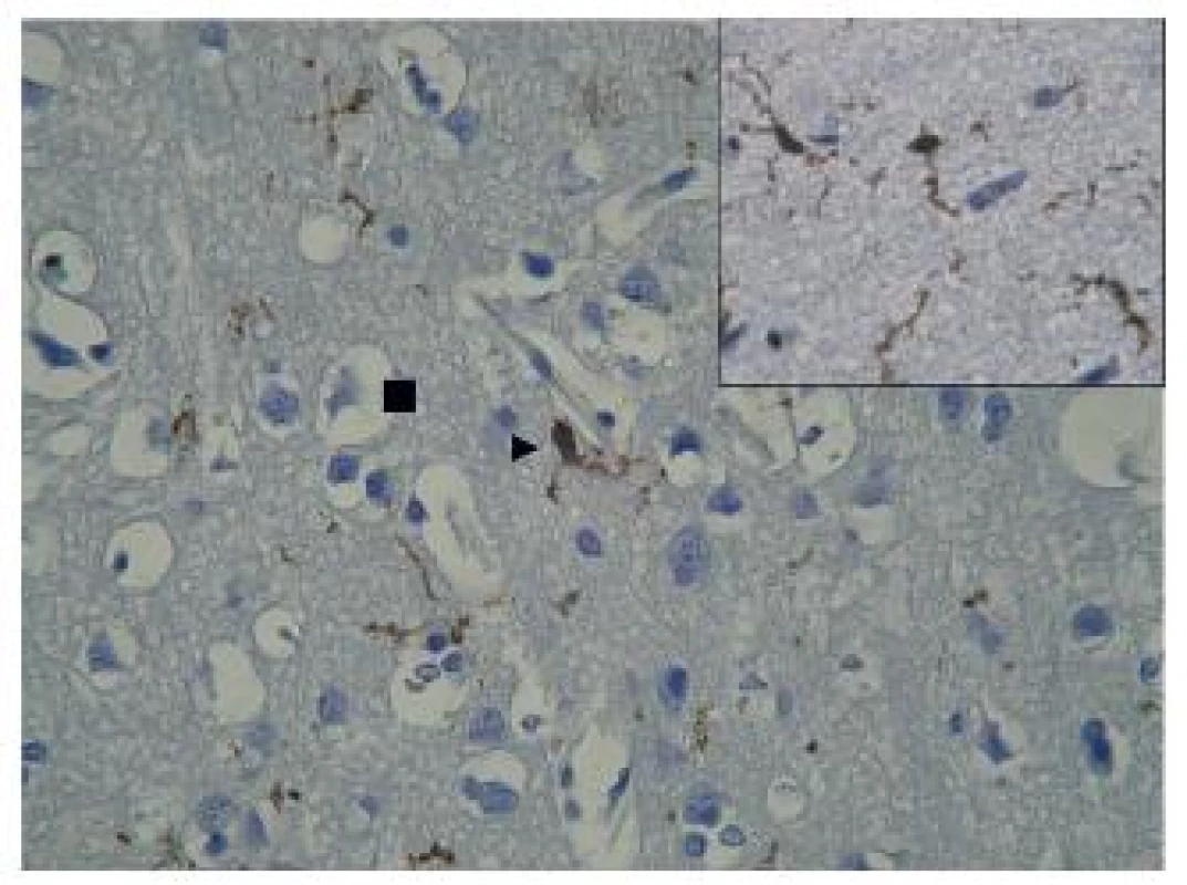 A 51 years old women cycling over the railway crossing who was knocked down by a lorry. Arrowhead indicates juxtavascular PSGL immunopositive microglial cells. Ramification and branching of microglial projections inside brain neurophil. MC – microglial cell. PSGL immunopositivity of MC (see in detail). Square indicates pericellular oedema.