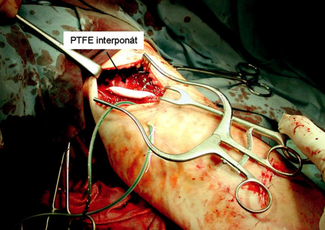 PTFE protézou nahrazená část perforované basilické žíly
Fig. 9. A PTFE prosthesis replacing a section of the perforated basilic vein