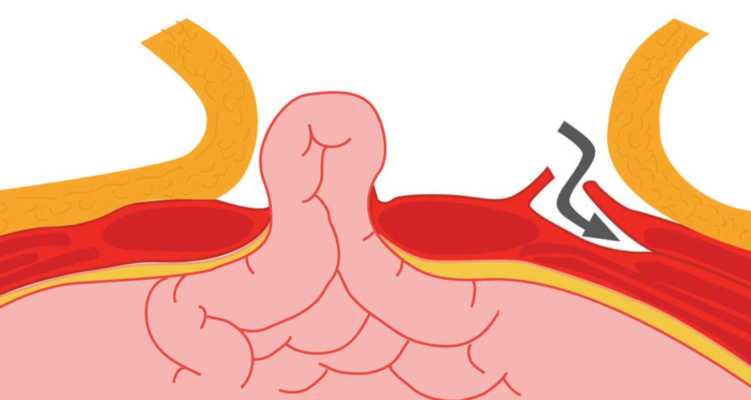 Schéma protnutí fascie zevního šikmého svalu v místě, kde přechází ve fascii přímých břišních svalů
Fig. 1: Diagram of the incision of the obliquus externus muscle fascia at the site of its transition into fascia of the rectus abdominis muscles
