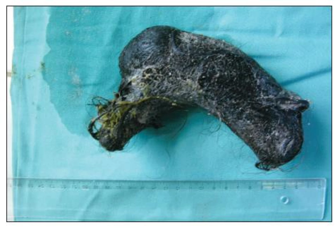 Trichobezoár, extrahovaný ze žaludku
Fig. 1. Trichobezoar, extracted from the girl‘s stomach